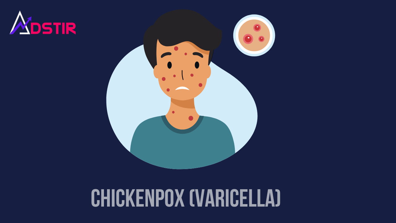 Chickenpox (varicella): Symptoms, treatments and more