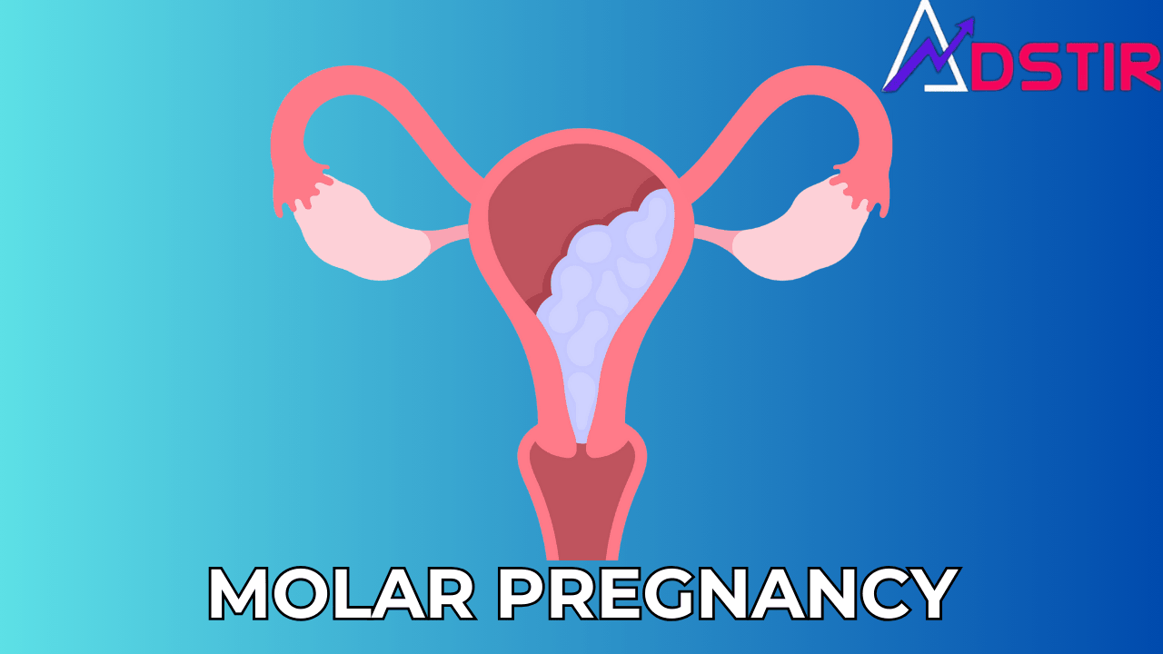 Molar Pregnancy